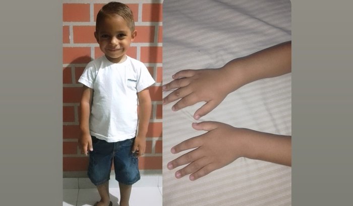 Deformidade De Madelung