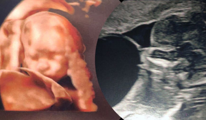 Matheo - Pequeno guerreiro com doença FETAL RARA (Megabexiga)