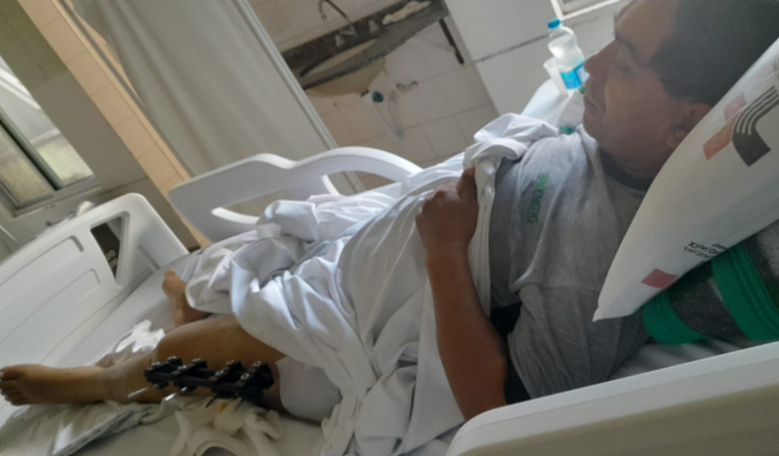 Acidente de moto com fratura exposta no fêmur