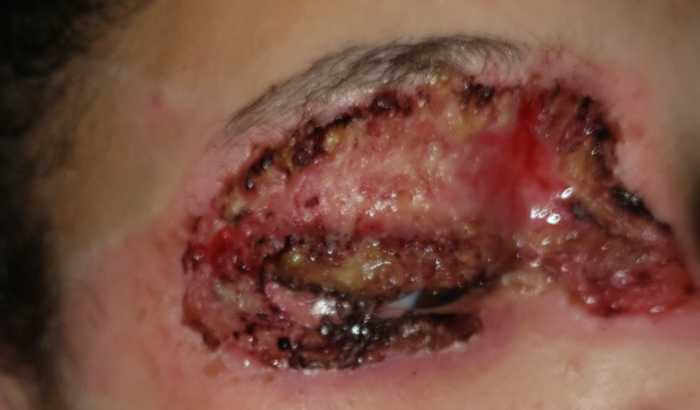 Cirurgia e tratamento