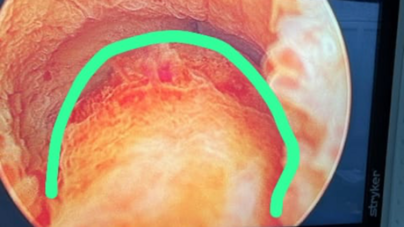 imagem da vaquinha Cirurgia de remoção do cisto de utrículo prostático