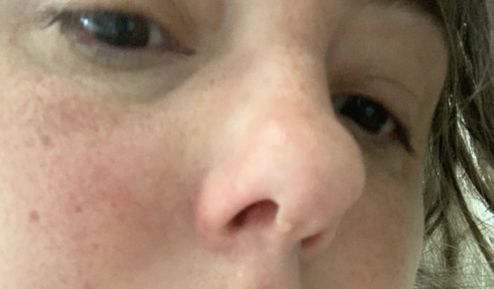 Tratamento e exame para fístula liquórica