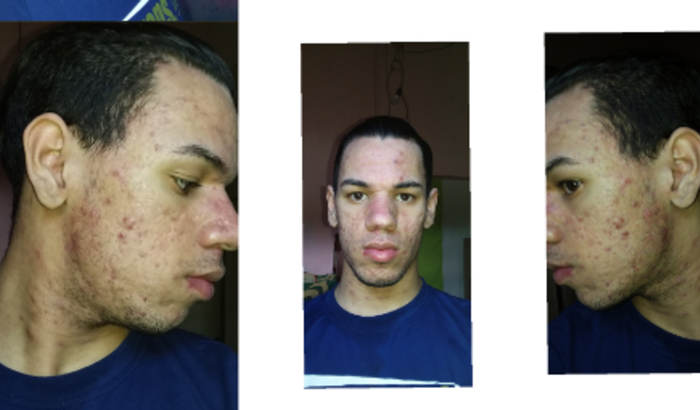 TRATAMENTO COM O ROACUTAM