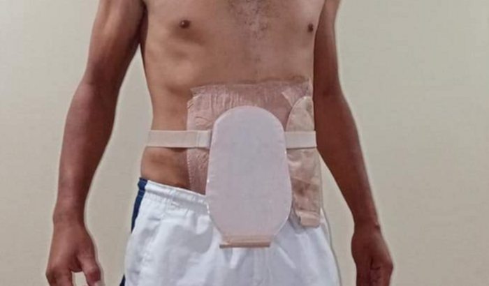 Cirurgia do Marcelo- Reversão Ostomia