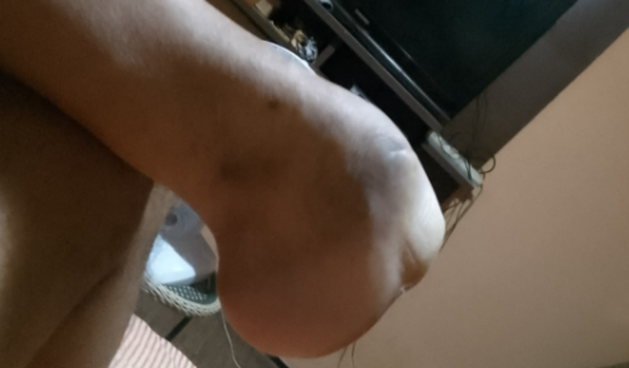 Quero uma prótese para meu antipé