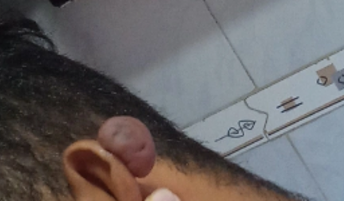 Pequena Cirurgia De Quelóide 