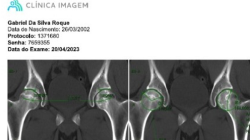 Prótese de fêmur para Gabriel 