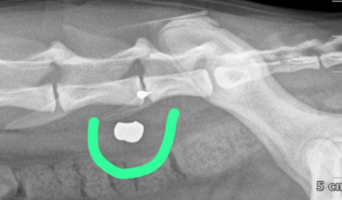 Cirurgia p retirada de um projétil p voltar andar