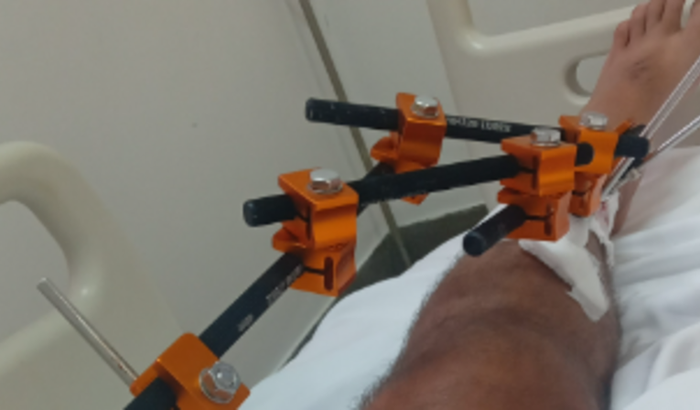 Acidente de moto 
