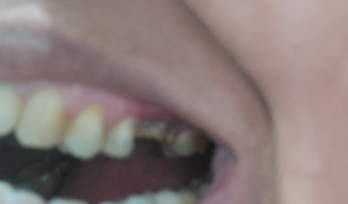 Preciso fazer dois implantes dentários 