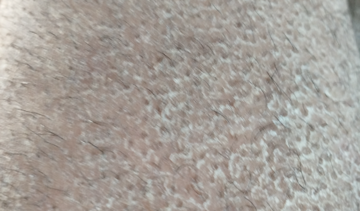 Medicamento acitretina 