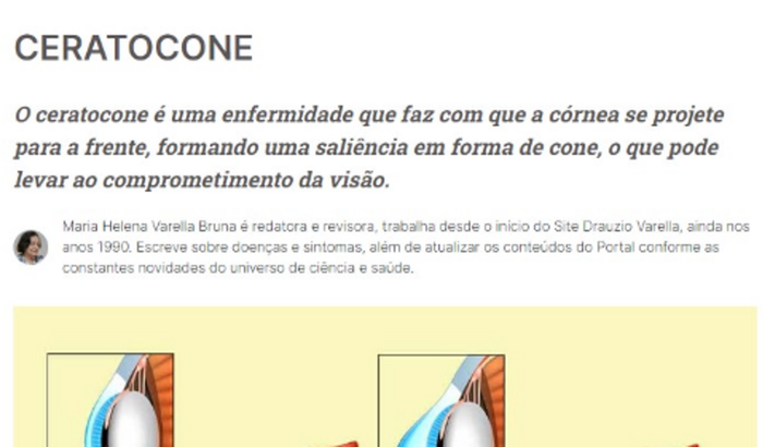 Tratamento de Ceratocone de Livia