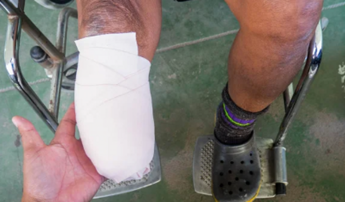 Perdi minha perna em um acidente de moto indo para o trabalho e hoje necessito de uma protesi para min poder trabalhar.