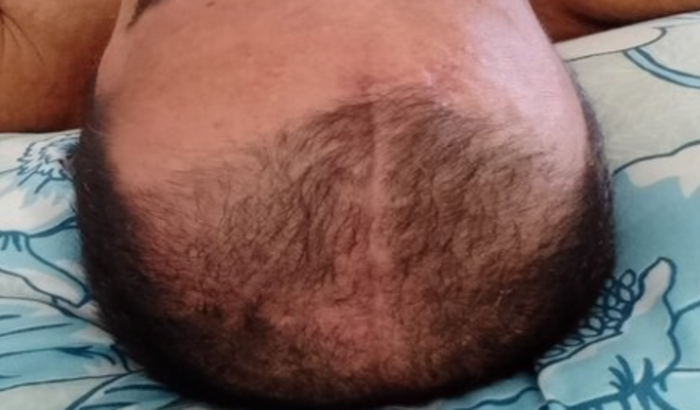 Ajuda para o tratamento de cancer do meu tio