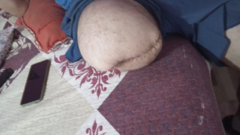 prótese para minha perna