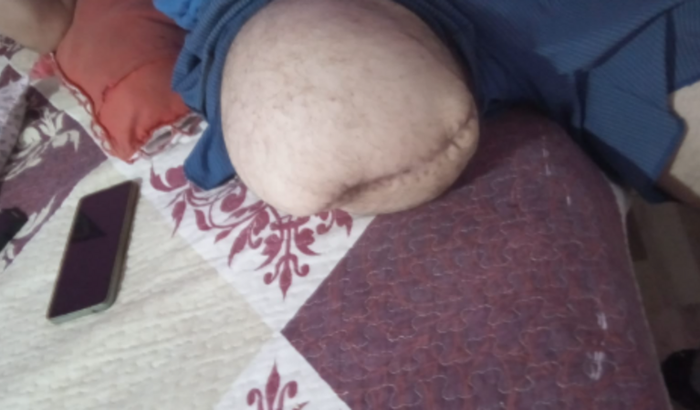 prótese para minha perna
