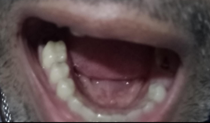 Implante Dentário 