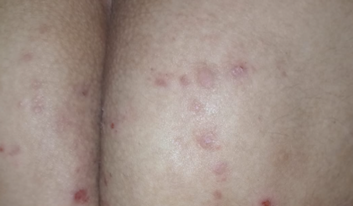 tratamento de urticaria cronicsa 