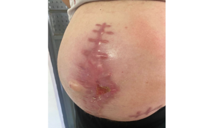 Cirurgia de Hérnia 