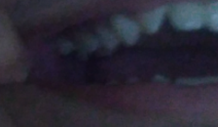 Retirar dente siso