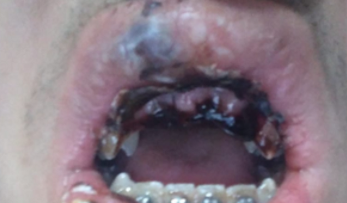 Meu amigo de 16 anos se acidentou e perdeu os dentes em um acidente.
