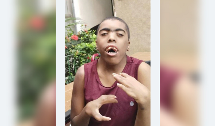 Ajude esse anjinho de 24 anos portador de Cornélia de Lange 