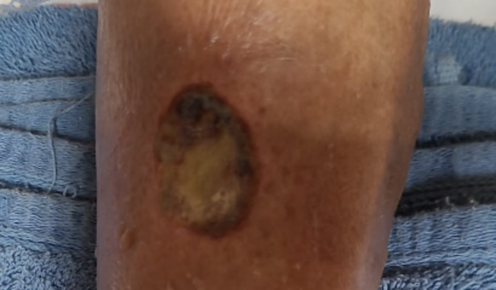 Ajuda para o tratamento de ferida necrosada de diabetes