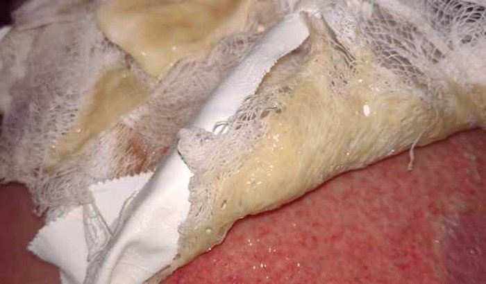 Quem poder ajudar minha cunhada, teve queimadura de 2 grau na perna