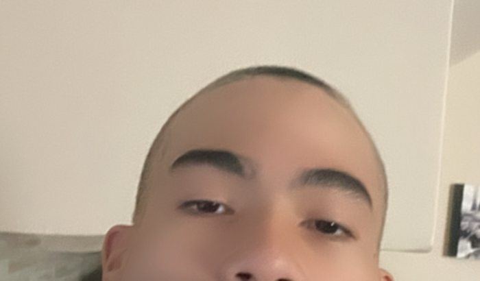 Tratamento da minha calvície 