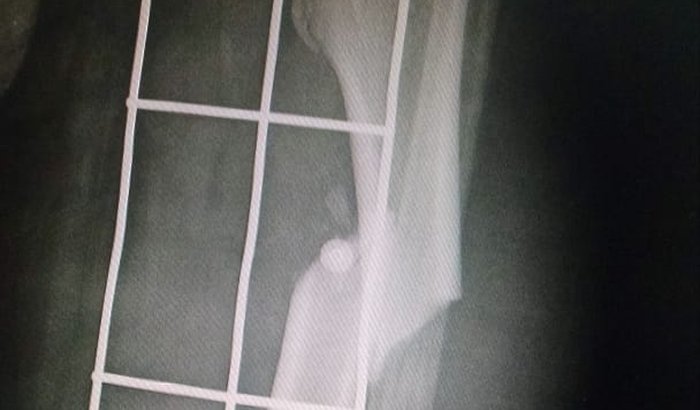 Cirurgia Ortopédica no Fêmur 