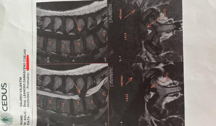 Cirurgia De Hérnia de Disco Tóraco Lombar