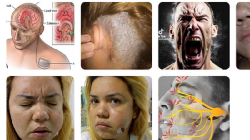 Cirurgia Neuralgia Do Trigêmeo DBS -  A Pior Dor do Mundo! 