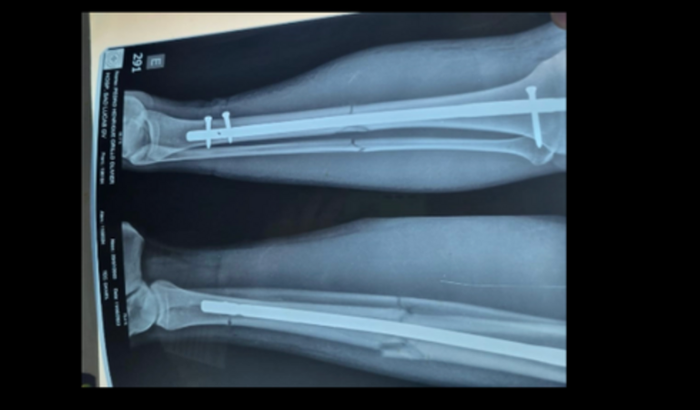 Ajudar a pagar os custos do atleta Grillo