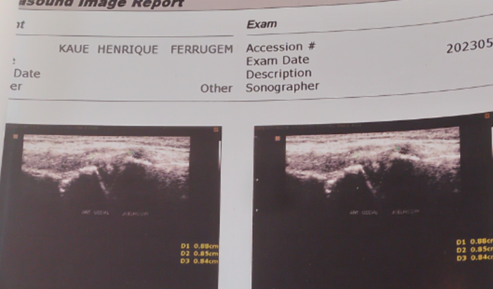 Cirurgia no joelho direito (lesão no menisco)