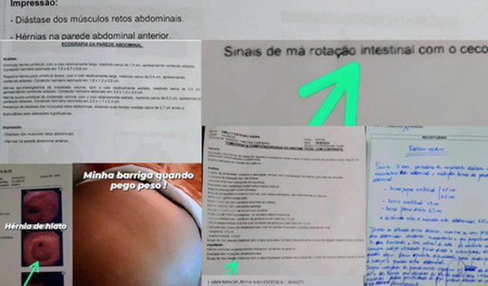 Múltiplas hérnias abdominais, incluindo a diástase de 7,4 cm, má rotação intestinal