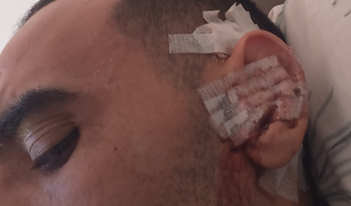 Ajuda na recuperação da cirurgia da A Pe Perda de audição de Cássio Artur Gurgel