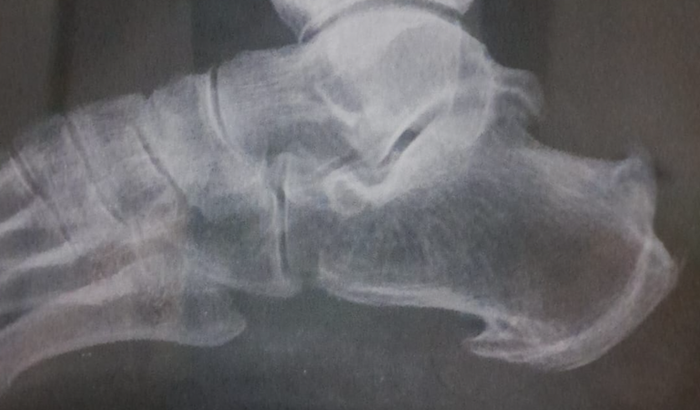 Cirurgia esporão calcâneo