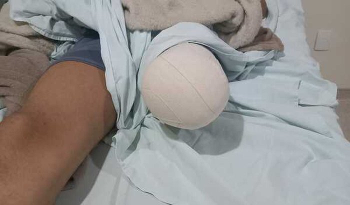 Ajude o Anderson a comprar uma prótese