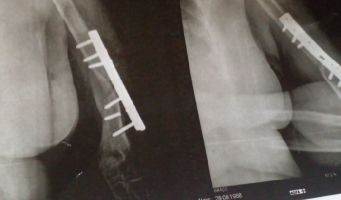 Ajuda em prol da cirurgia de troca de platina no braço.