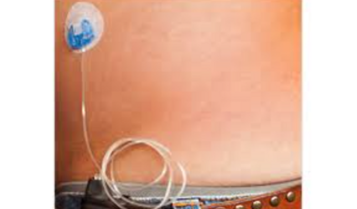 Ação judicial para conseguir a bomba de insulina