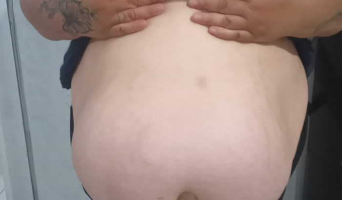 Cirurgia da Ernia Da Beti