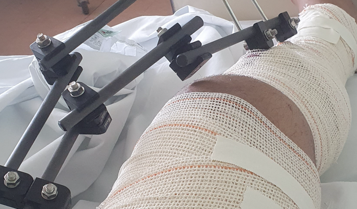 Quebrei a perna ,passei por 2 cirurgia, não estou trabalhando no momento, mim ajudem por favor, qualquer contia