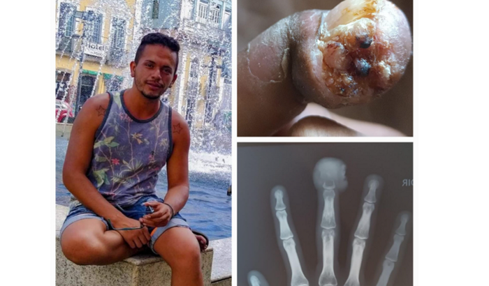 Cirurgia para tratar Câncer ósseo