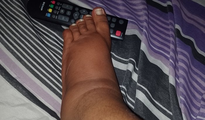 Vakinha pra ajudar no tratamento do meu pé!