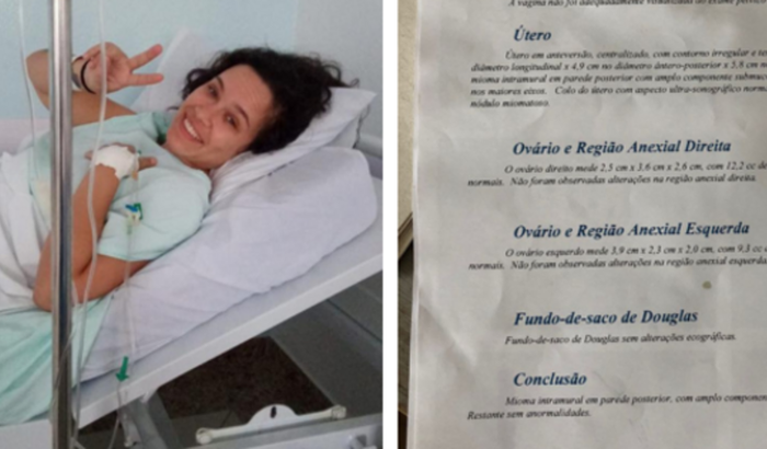 Retirada de mioma uterino que causa sangramento e hemorragia!