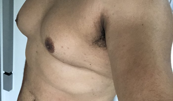 Ajuda para minha cirurgia de Ginecomastia