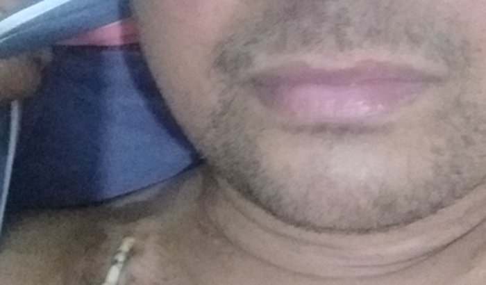 Trocar meu acesso para fazer hemodiálise