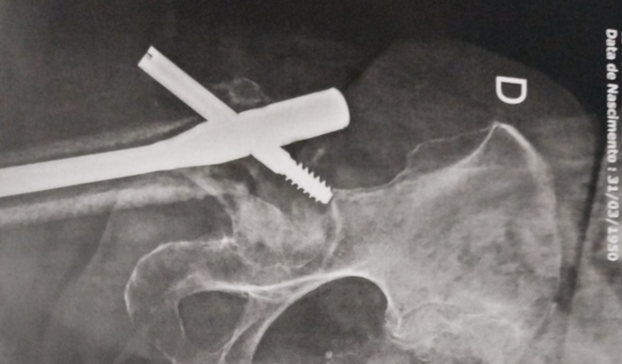 Desempregado e cuidando de minha mãe que sofreu um acidente doméstico