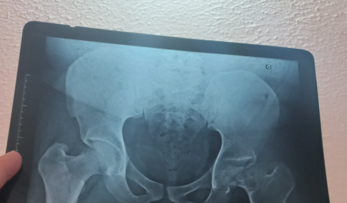 Artrose Avançada no Quadril