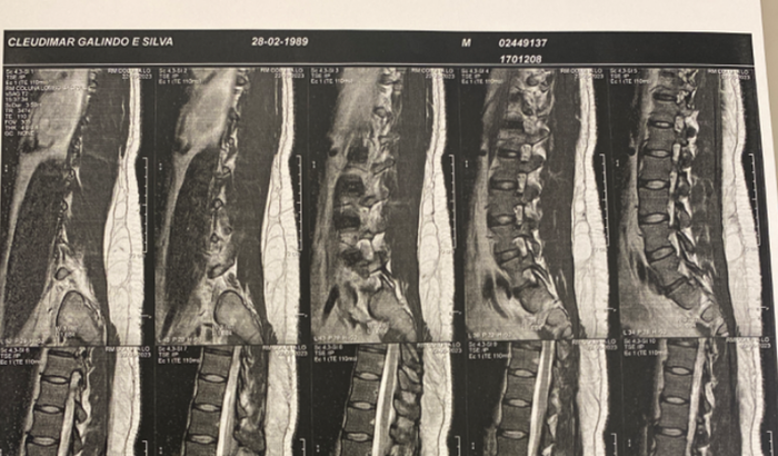 🆘Cirurgia urgente de hérnia de disco grave!🆘